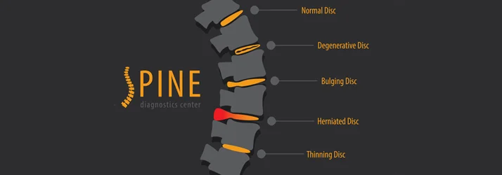 chiropractic care for sciatica and back pain